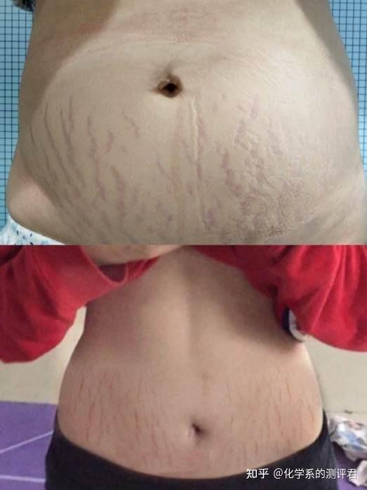 妊娠纹产品测评_孕妇防妊娠纹哪个牌子好_六位孕妈真实使用反馈