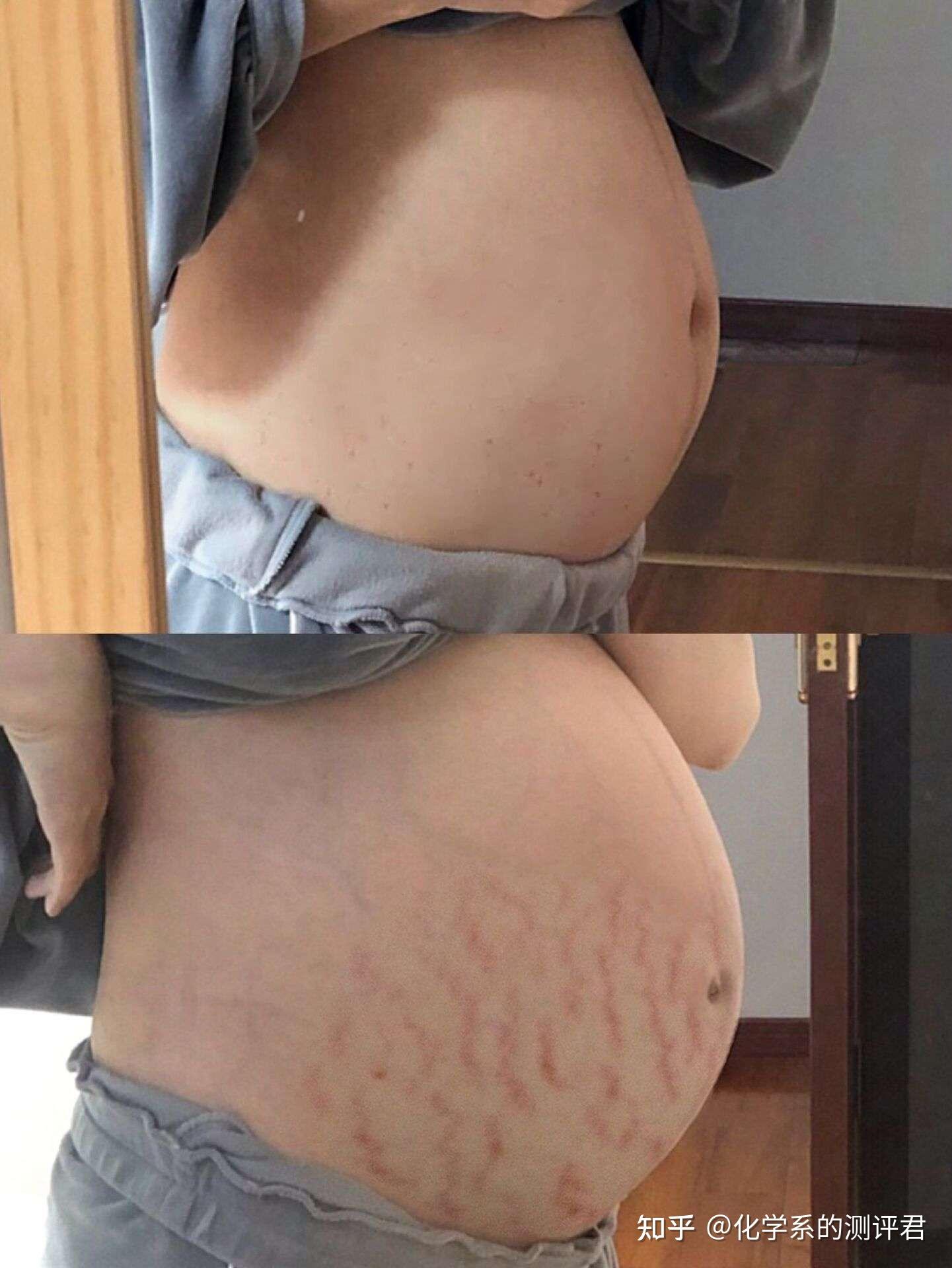 妊娠纹产品测评_孕妇防妊娠纹哪个牌子好_六位孕妈真实使用反馈