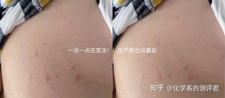 孕妇防妊娠纹哪个牌子好_六位孕妈真实使用反馈_妊娠纹产品测评