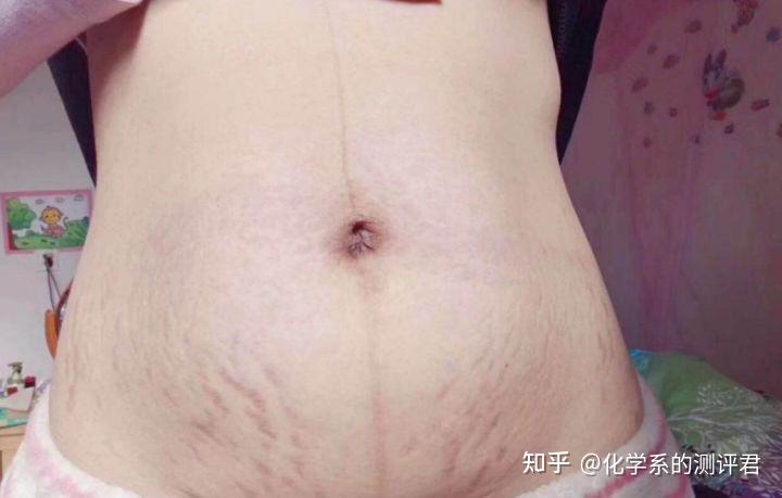 妊娠纹产品测评_六位孕妈真实使用反馈_孕妇防妊娠纹哪个牌子好
